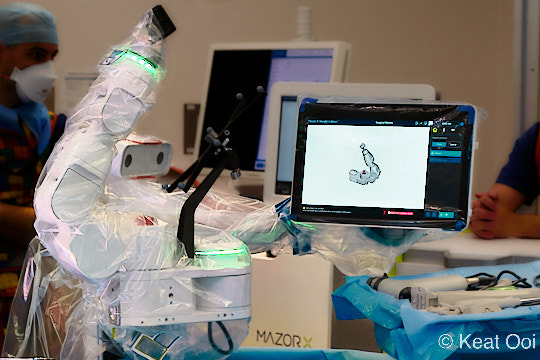 Mazor X Robotic Surgery Arm